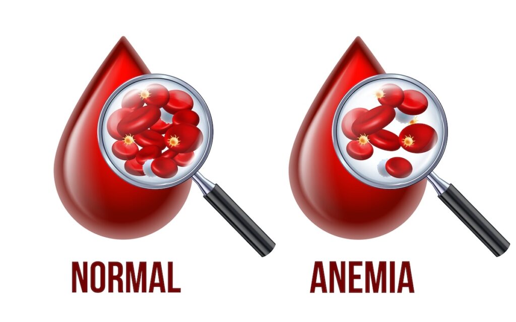 An example of healthy red blood cells versus anemic red blood cells